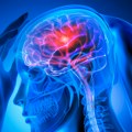 Moždani udar ne nastaje uvek zbog masnih naslaga u arterijama: Nova studija dovela u pitanje decenijama stara medicinska…