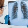 Svetski dan borbe protiv tuberkuloze: Rizik od epidemije i dalje postoji