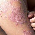 U Srbiji 140.000 ljudi boluje od psorijaze: Najveći problem - pacijenti se ne javljaju lekarima