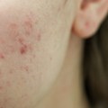 Bubuljice vam stalno izlaze na istom mestu na licu? Evo šta koža pokušava da vam poruči