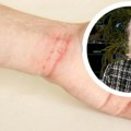 Šuga se može preneti i seksualnim putem Cela porodica mora da se leči, dr Maris otkrila sve simptome zarazne bolesti…