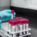 Razvijen novi test krvi koji dijagnostikuje sindrom hroničnog umora