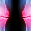 Osteoartritis: Optimističke prognoze za nove tretmane lečenja