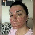 "Na par mesta se javilo krvarenje" Pevačica objavila sliku lica, sva u crvenilu: "Izgleda užasno i bolno"
