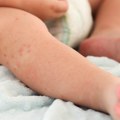Kako prepoznati ekcem kod beba i negovati nežnu kožu