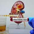 Kako se radi test klirens kreatinina? Vrednost koja najranije otkriva slabljenje bubrega pre pojave simptoma