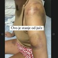 Izubijana, posečena, sva u masnicama: Ivana objavila slike nastale nakon superćelijske oluje u Kraljevu, doktor nije verovao…