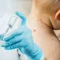 Od početka godine 197 slučajeva malih boginja u Srbiji