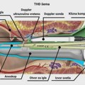 THD Metoda lečenja hemoroida na poliklinici Dr Nikolić u Nišu