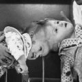 Рођене су са спојеним главама, а онда је 20 сати на операционом столу одредило њихову судбину