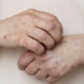 Treća žrtva malih boginja ove godine: Žena (40) preminula od komplikacija, SAD beleže najveću epidemiju za 35 godina