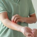 Razlog svraba kože nije uvek na njenoj površini: Skriveni uzroci koje dermatolozi pronalaze tokom opservacije