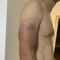 Pretučeni Kraljevčanin o brutalnosti policije nakon protesta