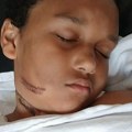Punjač se zapalio dok je dečak spavao, spržio mu vrat: Vrištao je upomoć, mama objavila jezive fotografije