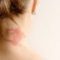 Kad svaki dodir peče: Dermatolog savetuje kako se boriti sa atopijskim dermatitisom VIDEO