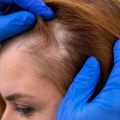 Alopecija, nepredvidiva autoimuna bolest koja odnosi kosu u pečatima