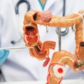 Zašto raste broj obolelih od raka debelog creva: Dr Trifunović objašnjava kada je operacija neizbežna i kakve su prognoze