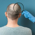 Zbogom ćelavosti? Naučnici otkrili šta bi moglo da pokrene ponovni rast kose