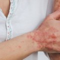 Sunčanje, uz oprez, može da ima pozitivan efekat na psorijazu