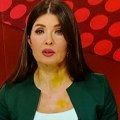 Šok scene u Dnevniku RTS-a: Voditeljka izgledala kao da je puna modrica, zbog haosa na mrežama morala da reaguje