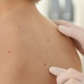 Ovčije boginje kod dece: Kako ih prepoznati, koliko traju i kada se treba javiti lekaru