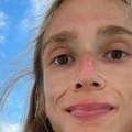 Devojka se izgladnela do smrti, imala je samo 22 kilograma: Živela je isključivo na voću, fotografije su horor