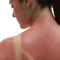 Hladne obloge umesto jogurta – kako pravilno tretirati opekotine od sunca