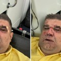 "Pokušaj ubistva!" Osvanula jeziva fotografija Saše Mirkovića nakon što je krvnički pretučen (foto)