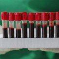 Test krvi mogao bi da ubrza otkrivanje 50 vrsta raka
