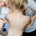 Može li Novi Pazar da bude novo žarište epidemije malih boginja: Lekari zabrinuti, mali obuhvat vakcinisane dece