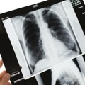 Istraživanje Udruženja pacijenata: Dijagnostika raka pluća je brža, ali pacijenti čekaju na primenu terapije
