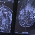 Onkolozi: Kancer izlečiv ukoliko se otkrije u najranijoj fazi