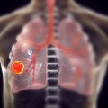 Napredak koji uliva nadu: Nova vakcina protiv raka pluća mogla bi da prepolovi broj smrtnih slučajeva