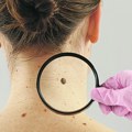 Pronašli karcinom kože na mestima gde ljudi nisu ni bili svesni da ga imaju Udruženje dermatovenerologa saopštilo…