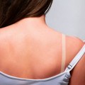 Pakleni svrab posle opekotina od sunca: Simptomi i prirodno lečenje