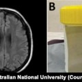 Živi crv pronađen u mozgu pacijentkinje u Australiji