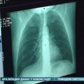 Više od 11 hiljada građana koji spadaju u rizičnu grupu za dobijanje raka pluća