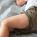 У земљи у коју Срби путују на море хара зараза: Због лажне имунизације букнула болест
