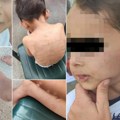 Otac sinu (5) gasio cigarete po telu i licu? Osumnjičeni roditelj iz Kovina se branio: "Dete laže, to su mu rane od ujeda…