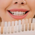 Blistavi i zdravi zubi u proleće: Razlike između izbeljivanja zuba i Hollywood Smile
