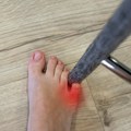 Slomljeni nožni prst ili samo ugruvan: Kako ih razlikovati i šta nikako ne treba raditi