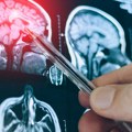Moždana aneurizma: Ne daje simptome, ljudi i ne znaju da nose tempiranu bombu! Evo šta je savet neurohirurga