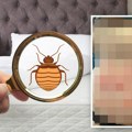 Ženu izujedale stenice u hotelu u Zagrebu: Objavila fotografije tela, stravične su