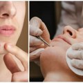 Potkožna bubuljica vas muči? Ove proverene metode ubrzavaju proces i olakšavaju bol, ali jednu grešku nikako ne smete napraviti…