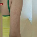 Decu iz Srbije u letnjem kampu unakazile stenice! Selenina ćerka završila sa plikovima od glave do pete, a u koferu su tek…