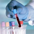 Ako vam izlaze modrice po telu, ovo morate da znate: Nije opasno samo u ovom slučaju, objasnio hematolog