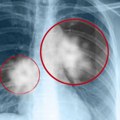 Pulmolog UKCS: Zbog ove tri stvari sve više ljudi u Srbiji boluje od astme! Prekinite sa ovim odmah!