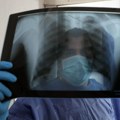 Rak pluća godišnje odnese 5.000 života u Srbiji: Prevencija i rano otkrivanje ključni