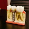 Oporavak nakon ugradnje zubnih implantata – koliko traje i šta očekivati?