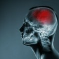 Skriveni izazivač moždanog udara: Ruski naučnici otkrili faktor rizika